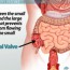 ileocecal-valve-diagram